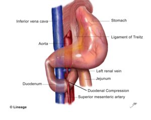 Superior Mesenteric Artery Syndrome (SMA) — Duodenal compression diagnosed by Dr. Osama Hamed
