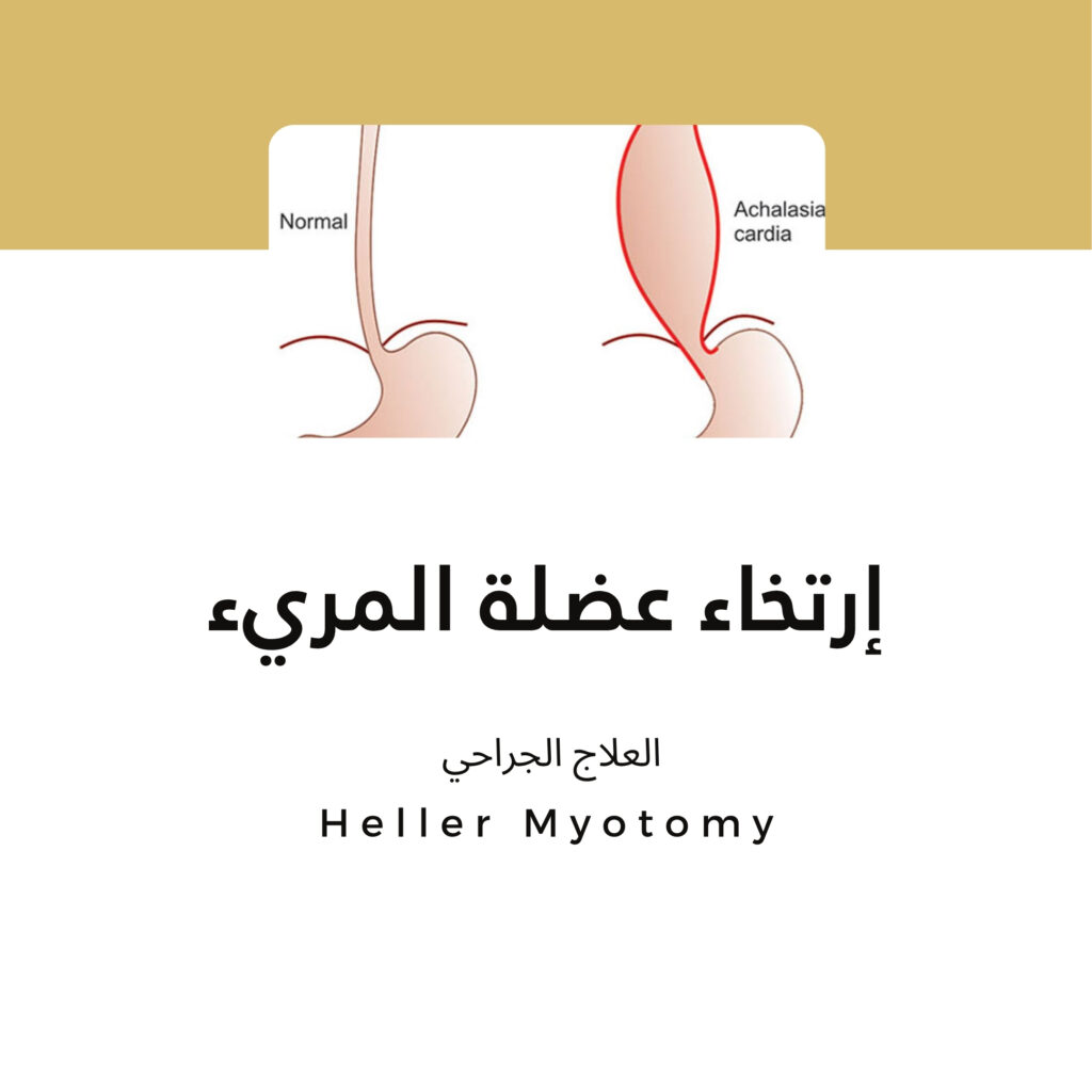 إرتخاء عضلة المريء اكاليزياء