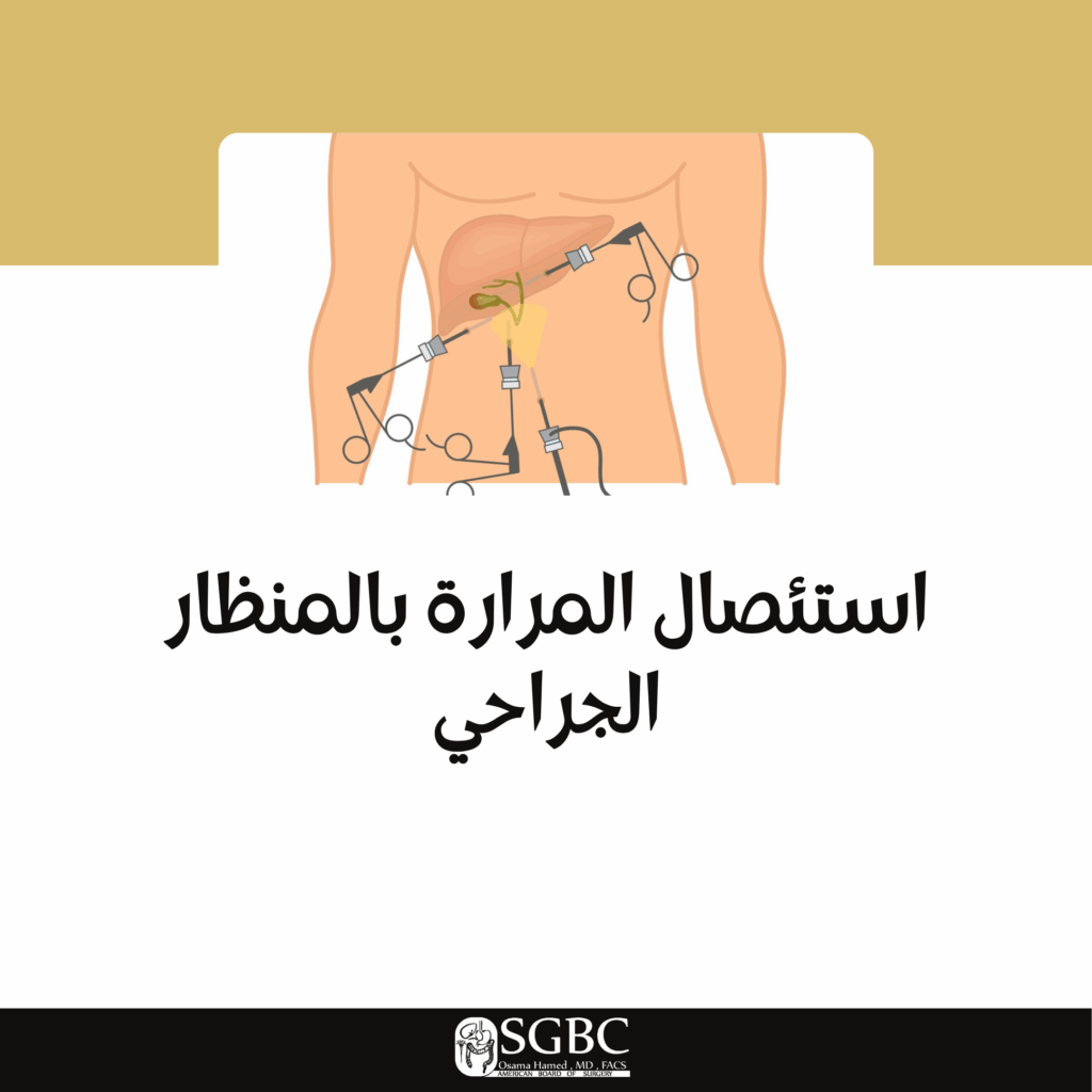 استئصال المرارة بالمنظار الجراحي – د. أسامة حامد